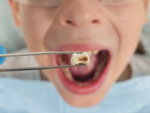 Best Emergency Broken Tooth Repair in Excelsior, MN